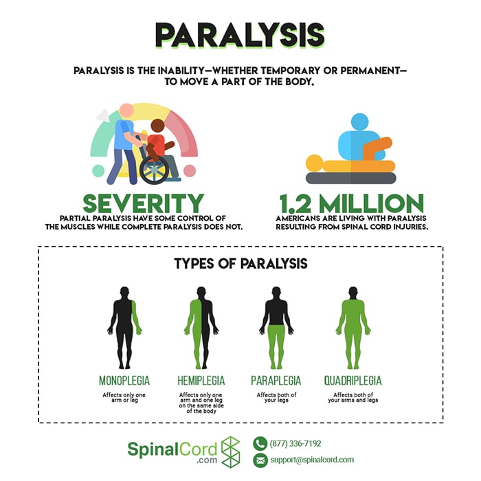 Typer Af Lammelse: Monoplegi, Hemiplegi, Paraplegi Og Kvadriplegi ...